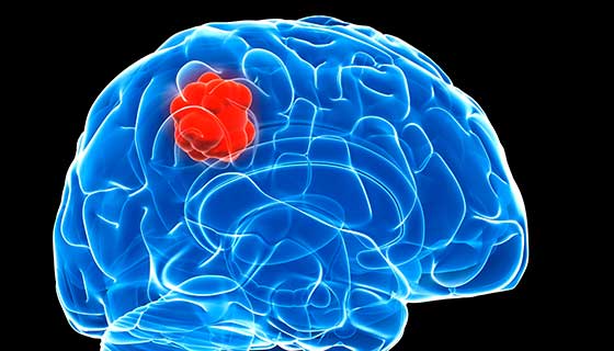 What Causes of Thunderclap headache?